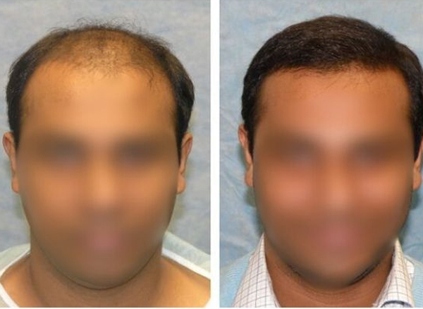 Before and After 4
