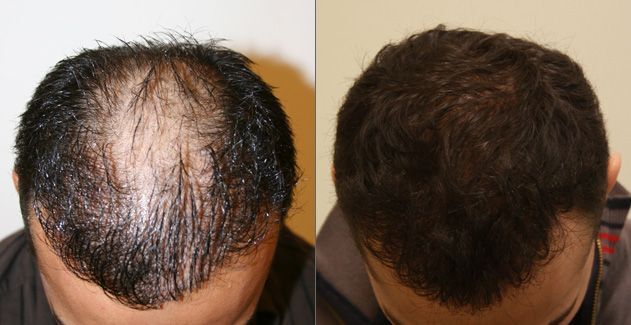 Benefits of Hair Transplants